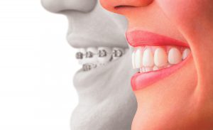 invisalign2